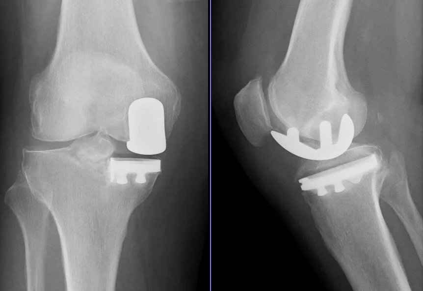 Duas radiografias de joelho lado a lado: à esquerda uma prótese parcial, que substitui só um lado da articulação; à direita uma prótese total, que recobre toda a extremidade do fêmur