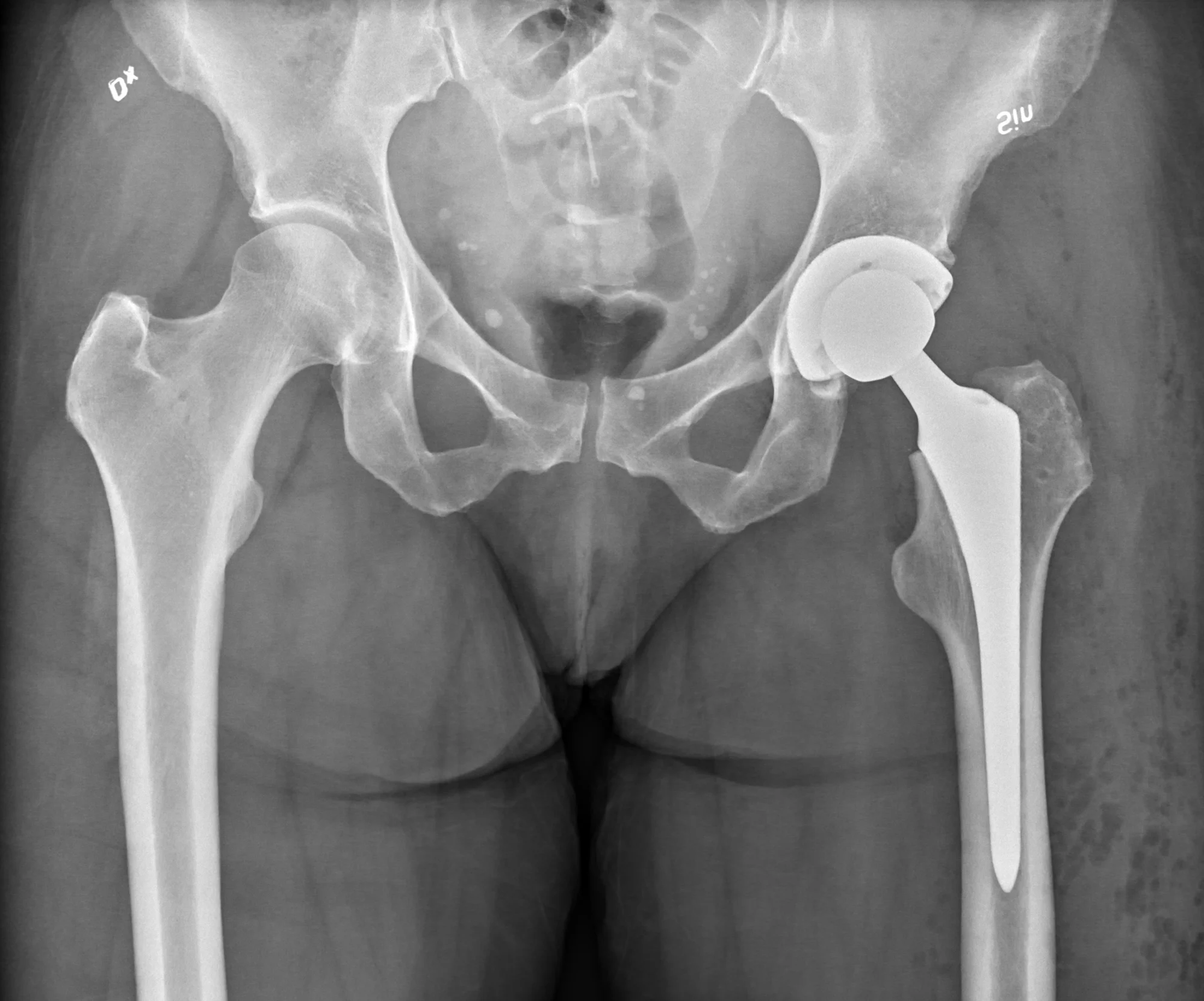 Radiografia da bacia de frente: no quadril esquerdo há uma prótese total, com a cúpula na bacia e a haste dentro do fêmur; o quadril direito é o do próprio paciente, sem prótese