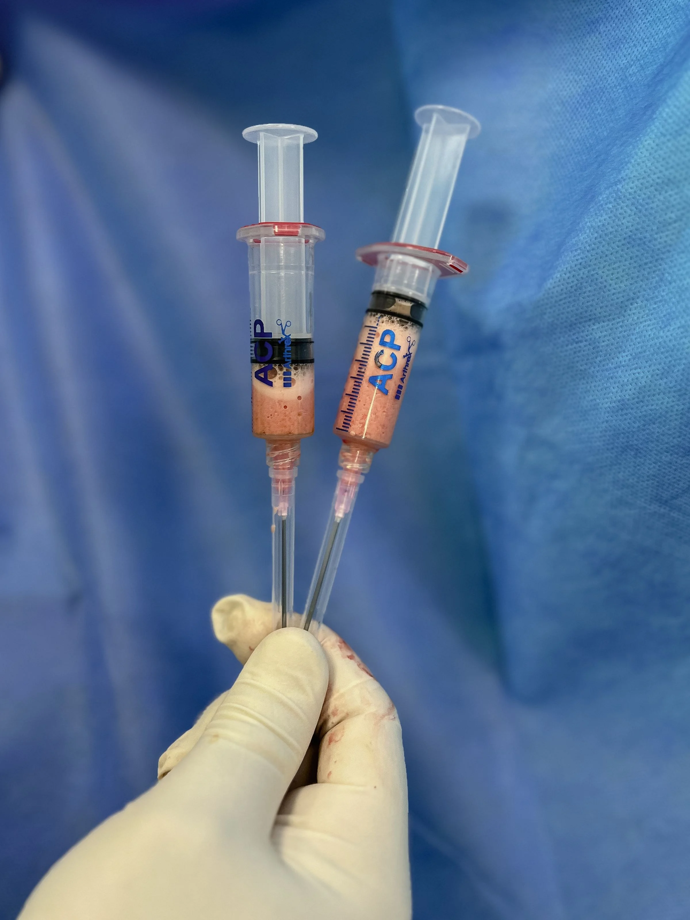 Duas seringas com plasma rico em plaquetas seguradas por mão enluvada em campo cirúrgico azul
